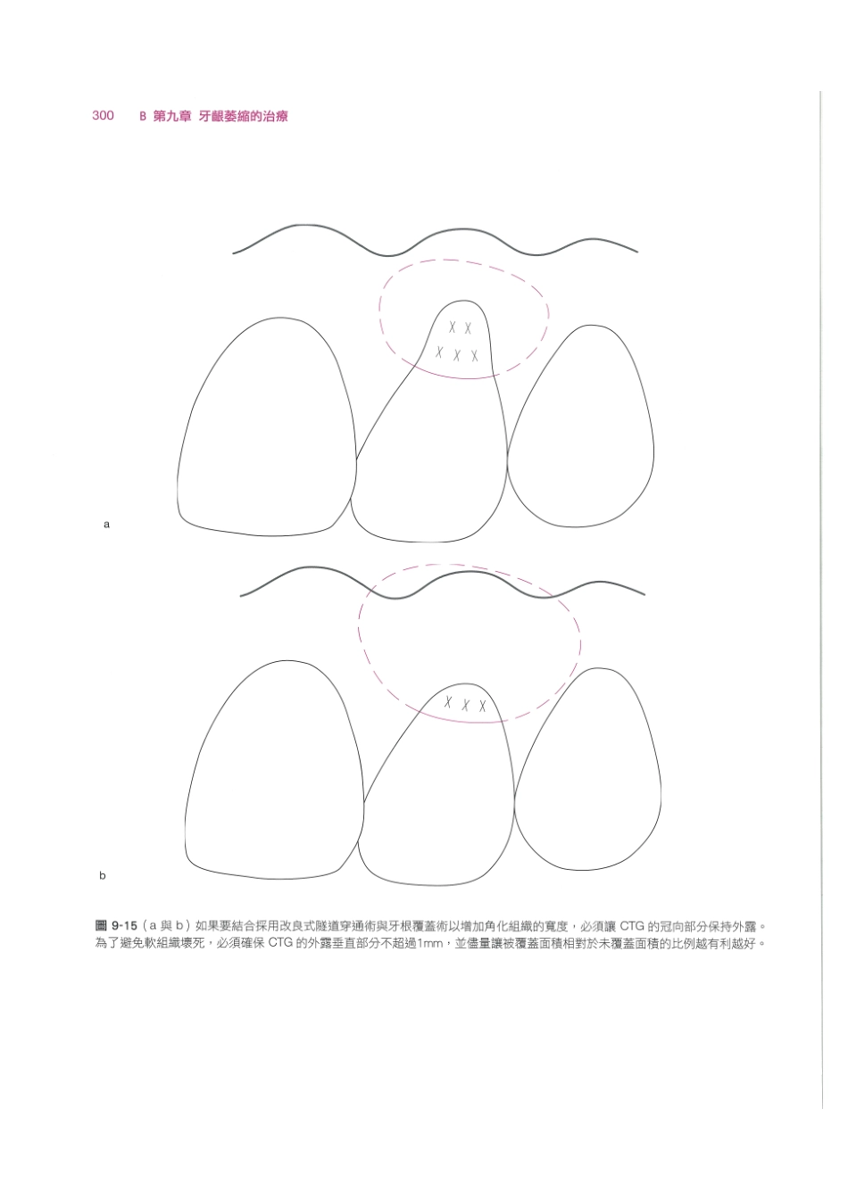 179.牙周整形美容与种植手术_313-320.pdf_第2页