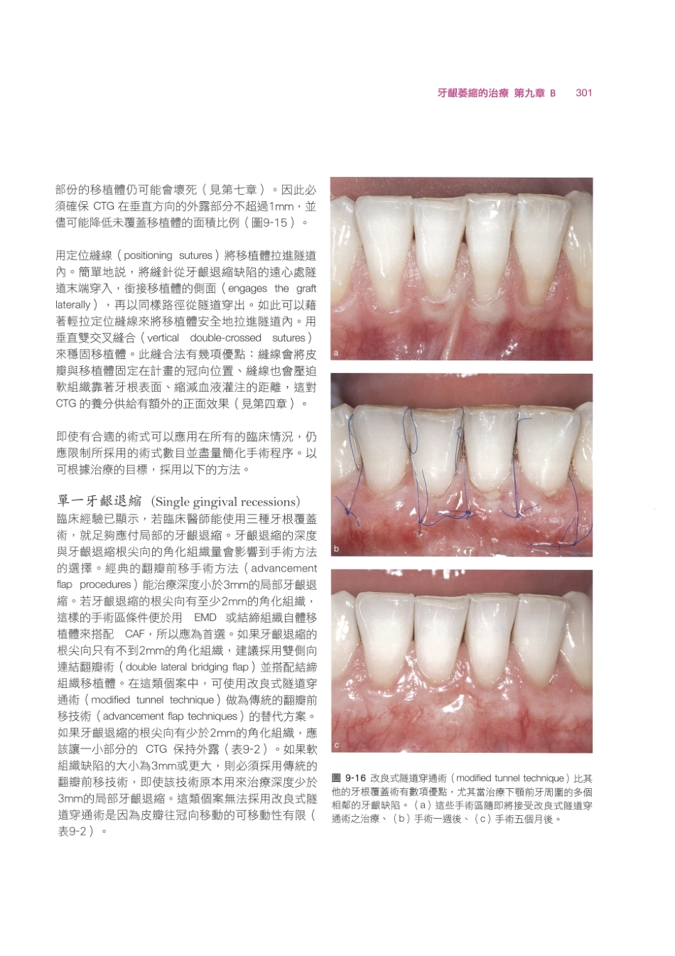 179.牙周整形美容与种植手术_313-320.pdf_第3页