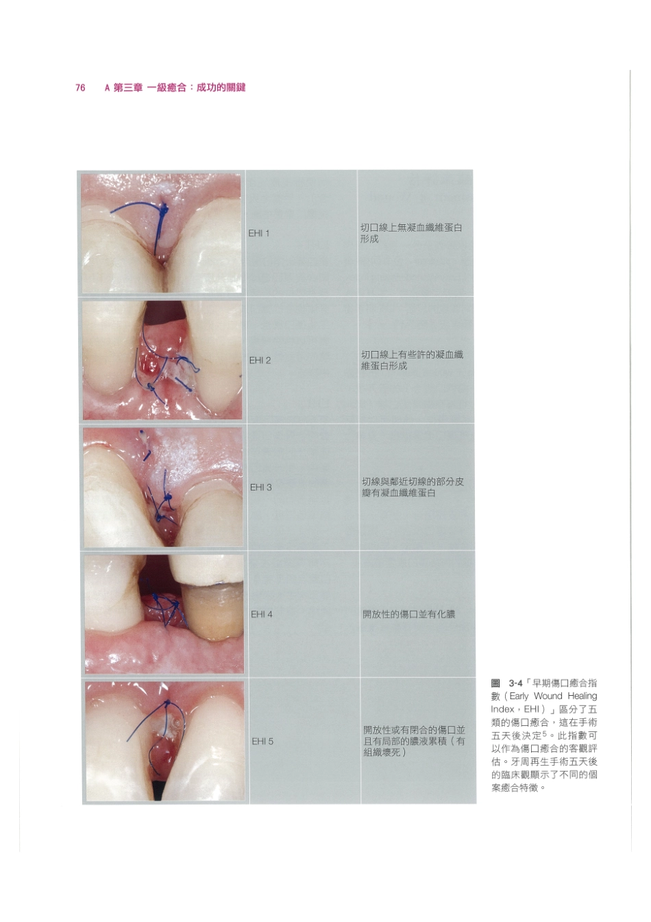 179.牙周整形美容与种植手术_89-96.pdf_第2页