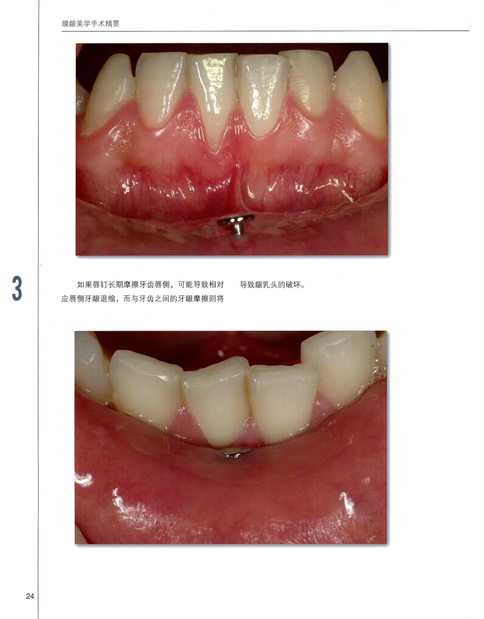 184膜龈美学手术精要_41-60.pdf_第1页