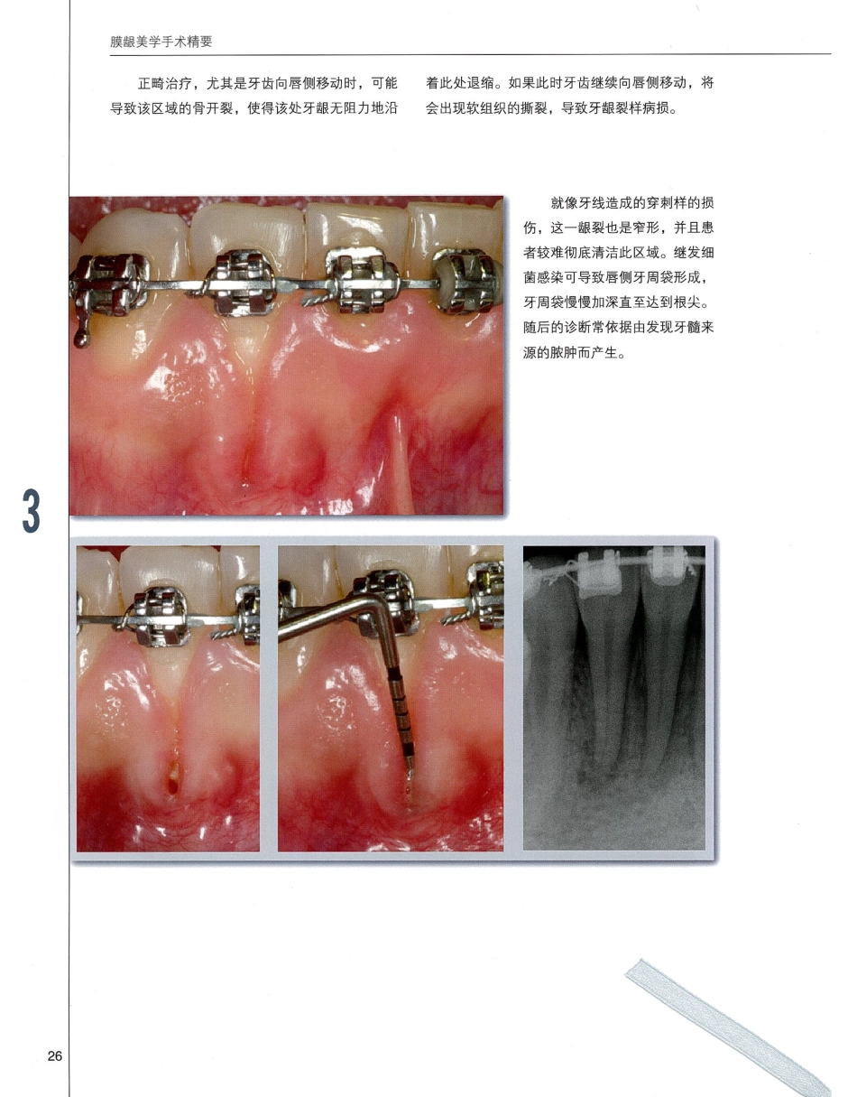 184膜龈美学手术精要_41-60.pdf_第3页