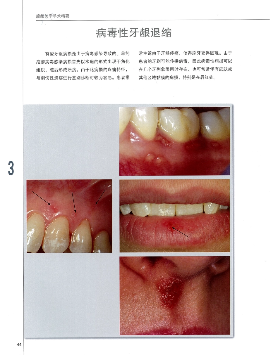 184膜龈美学手术精要_61-80.pdf_第1页