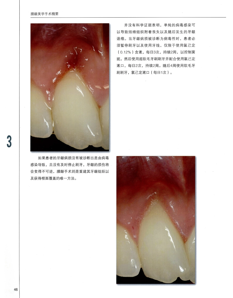 184膜龈美学手术精要_61-80.pdf_第3页