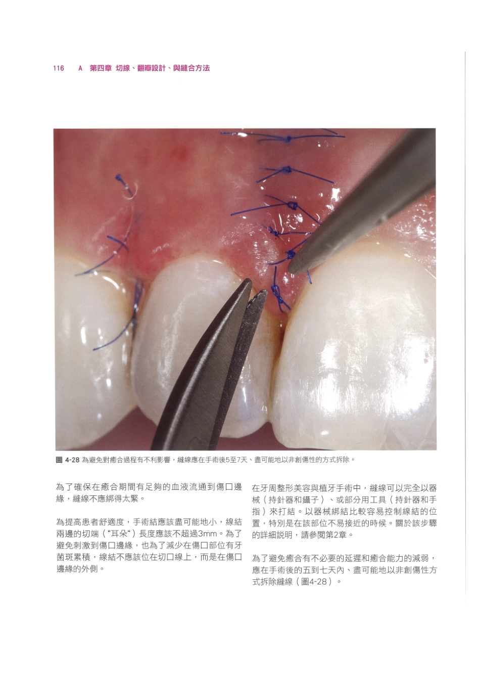 179.牙周整形美容与种植手术_129-136.pdf_第2页