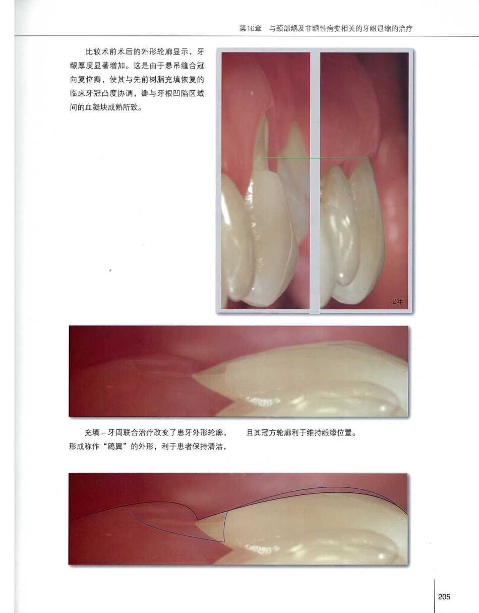 184膜龈美学手术精要_221-240.pdf_第2页