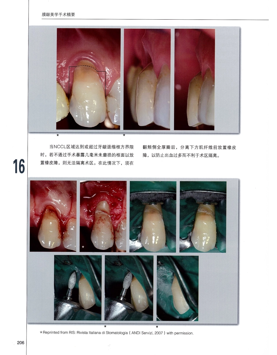 184膜龈美学手术精要_221-240.pdf_第3页