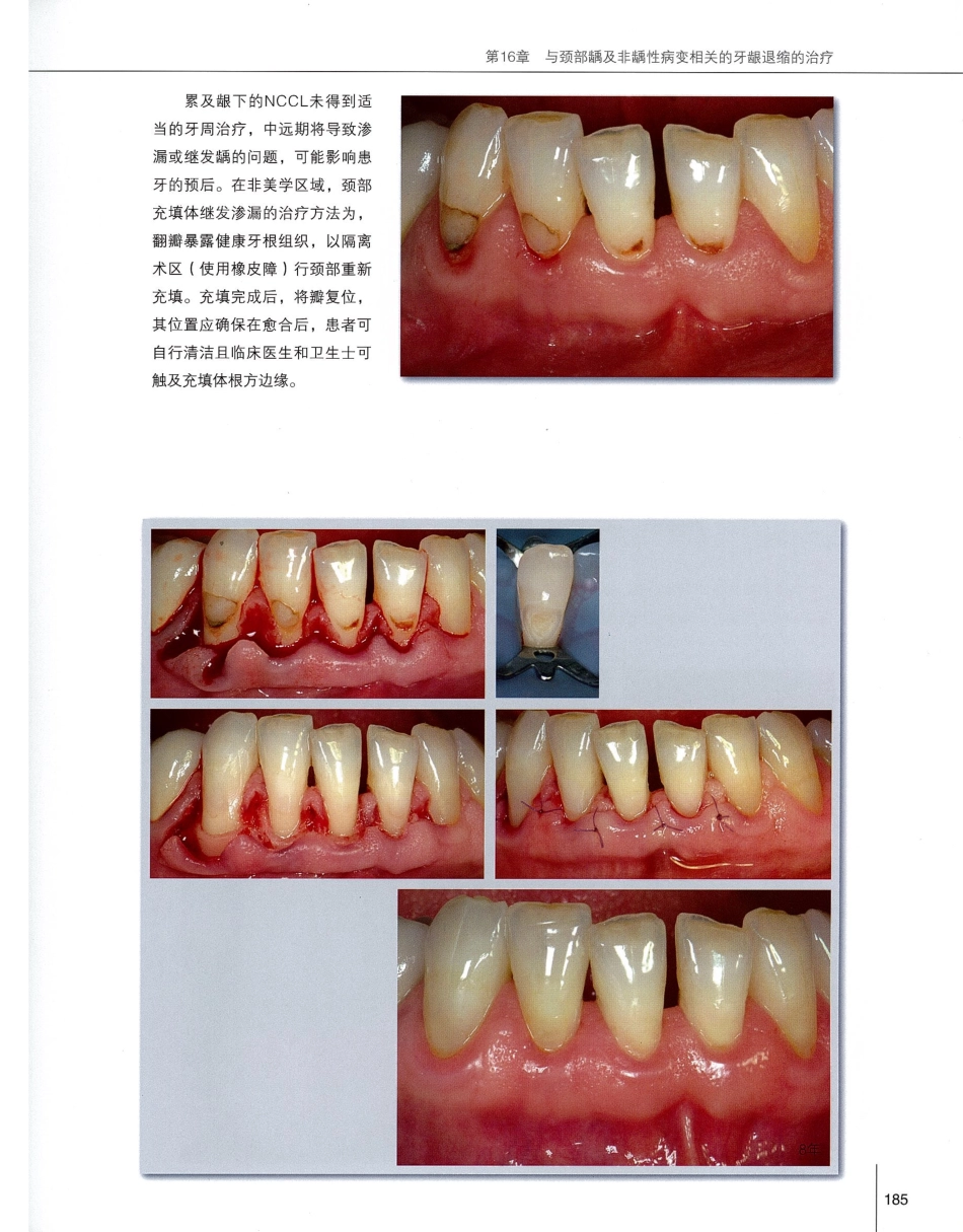 184膜龈美学手术精要_201-220.pdf_第2页