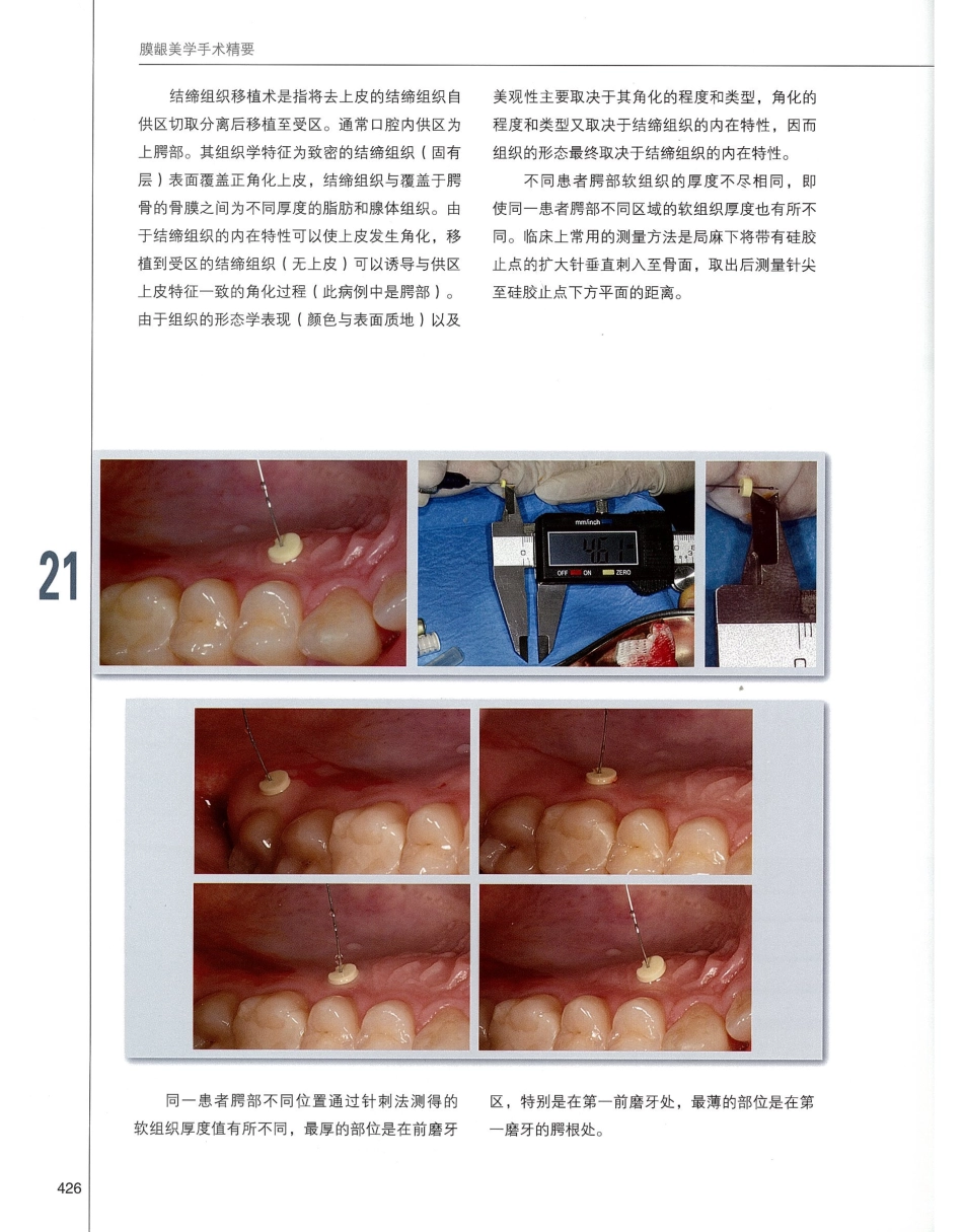 184膜龈美学手术精要_441-460.pdf_第3页