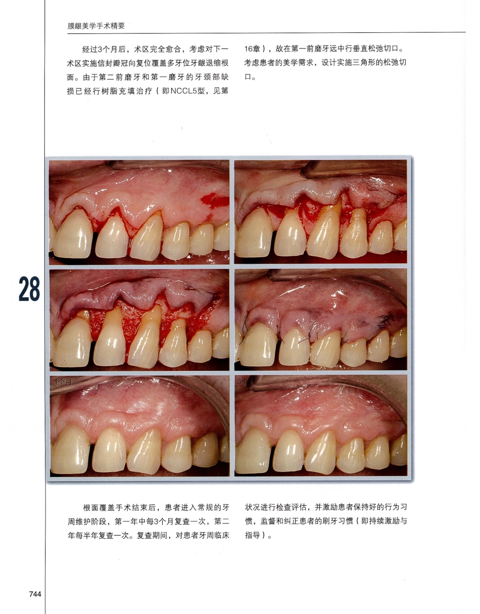 184膜龈美学手术精要_761-780.pdf_第1页