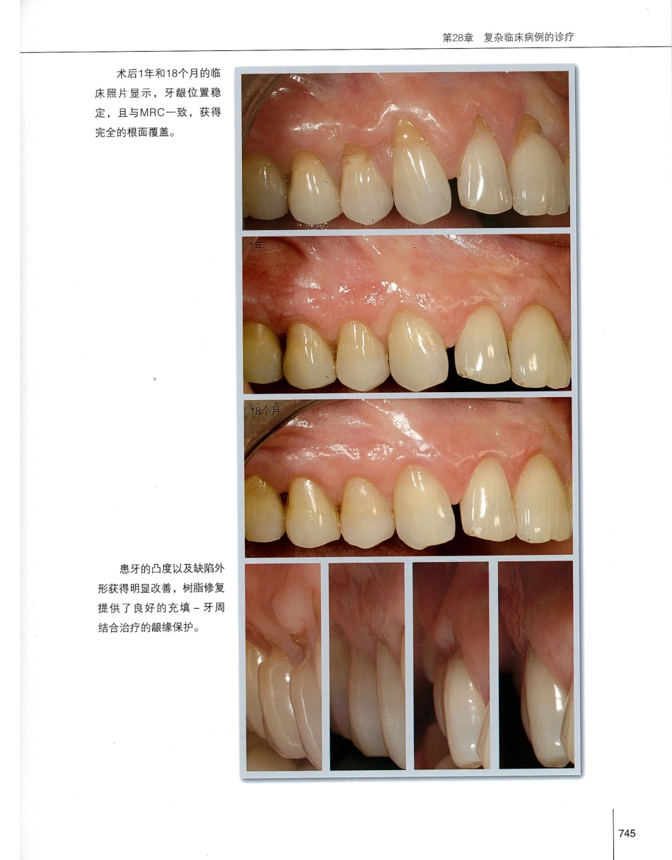 184膜龈美学手术精要_761-780.pdf_第2页