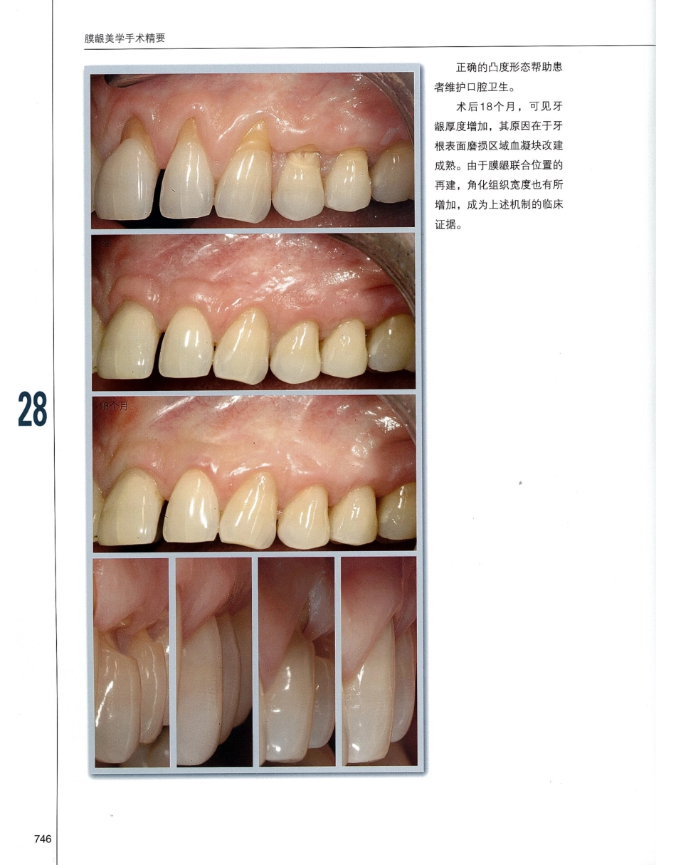 184膜龈美学手术精要_761-780.pdf_第3页