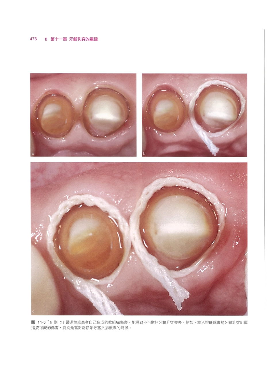 179.牙周整形美容与种植手术_489-496.pdf_第2页