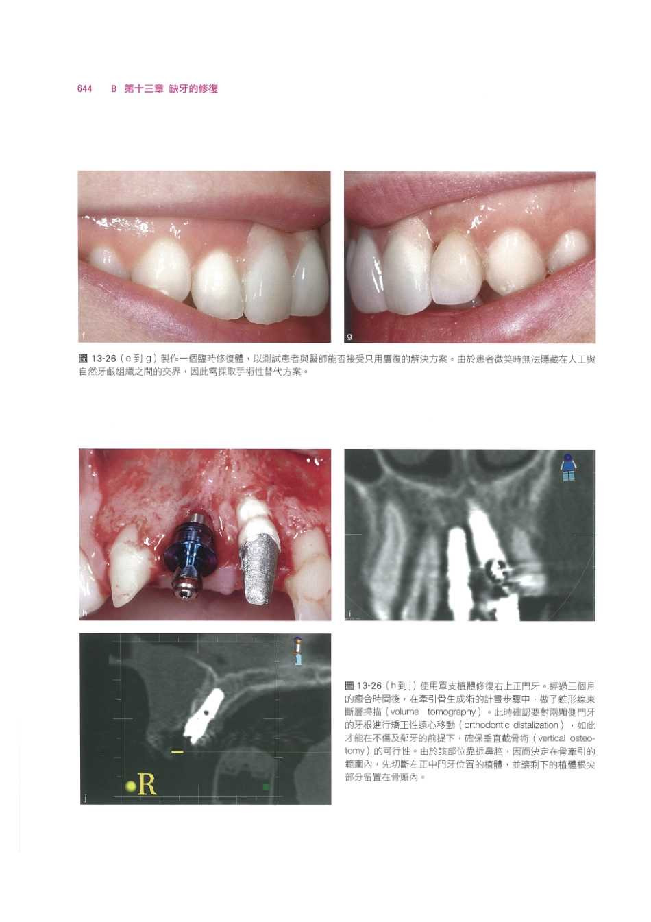 179.牙周整形美容与种植手术_657-664.pdf_第2页