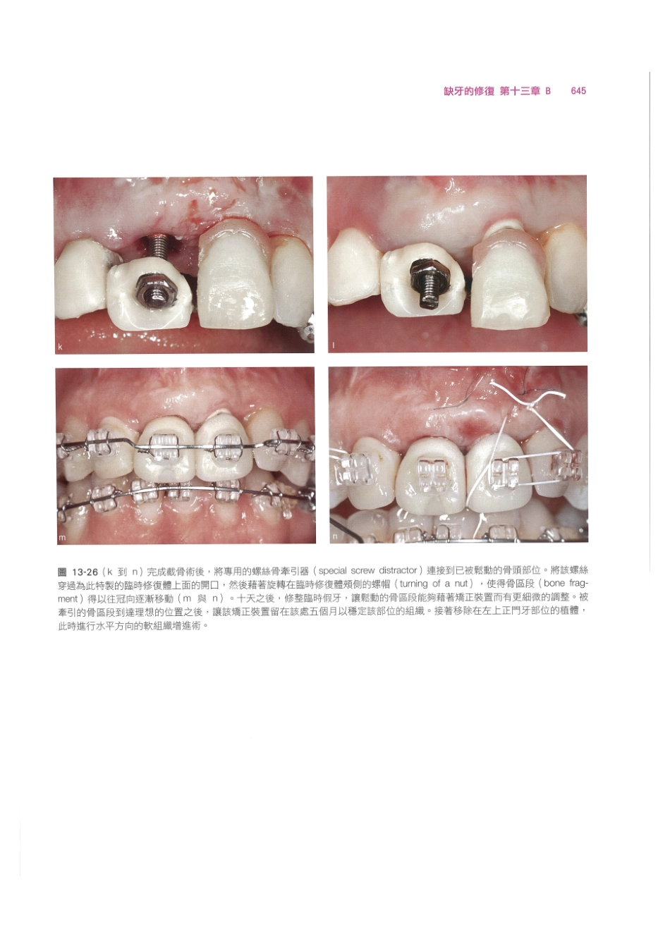 179.牙周整形美容与种植手术_657-664.pdf_第3页