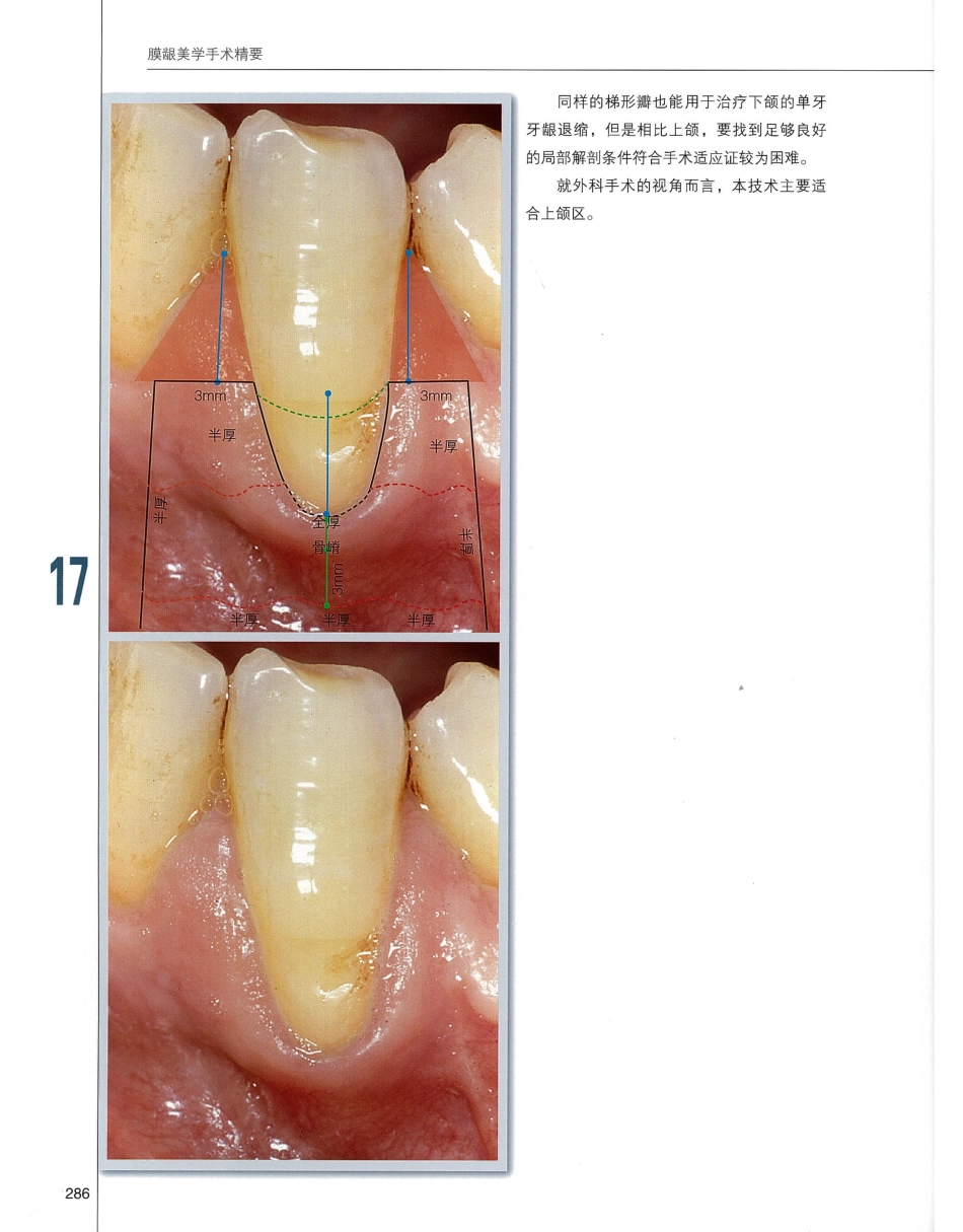 184膜龈美学手术精要_301-320.pdf_第3页