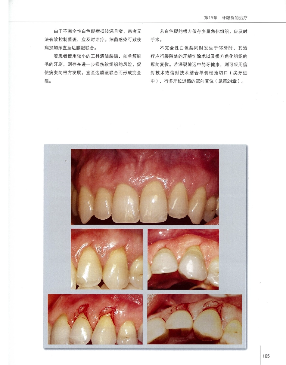 184膜龈美学手术精要_181-200.pdf_第2页