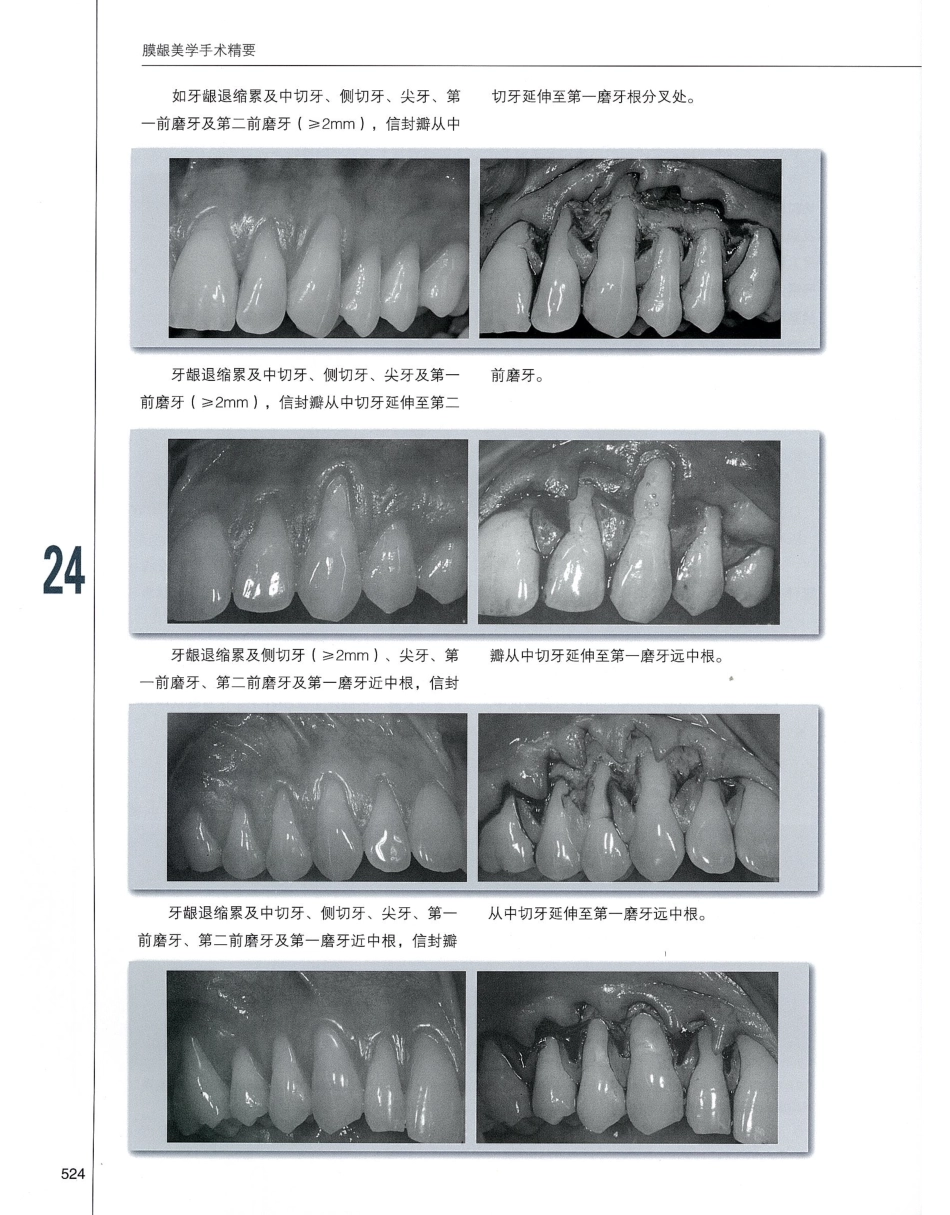 184膜龈美学手术精要_541-560.pdf_第1页