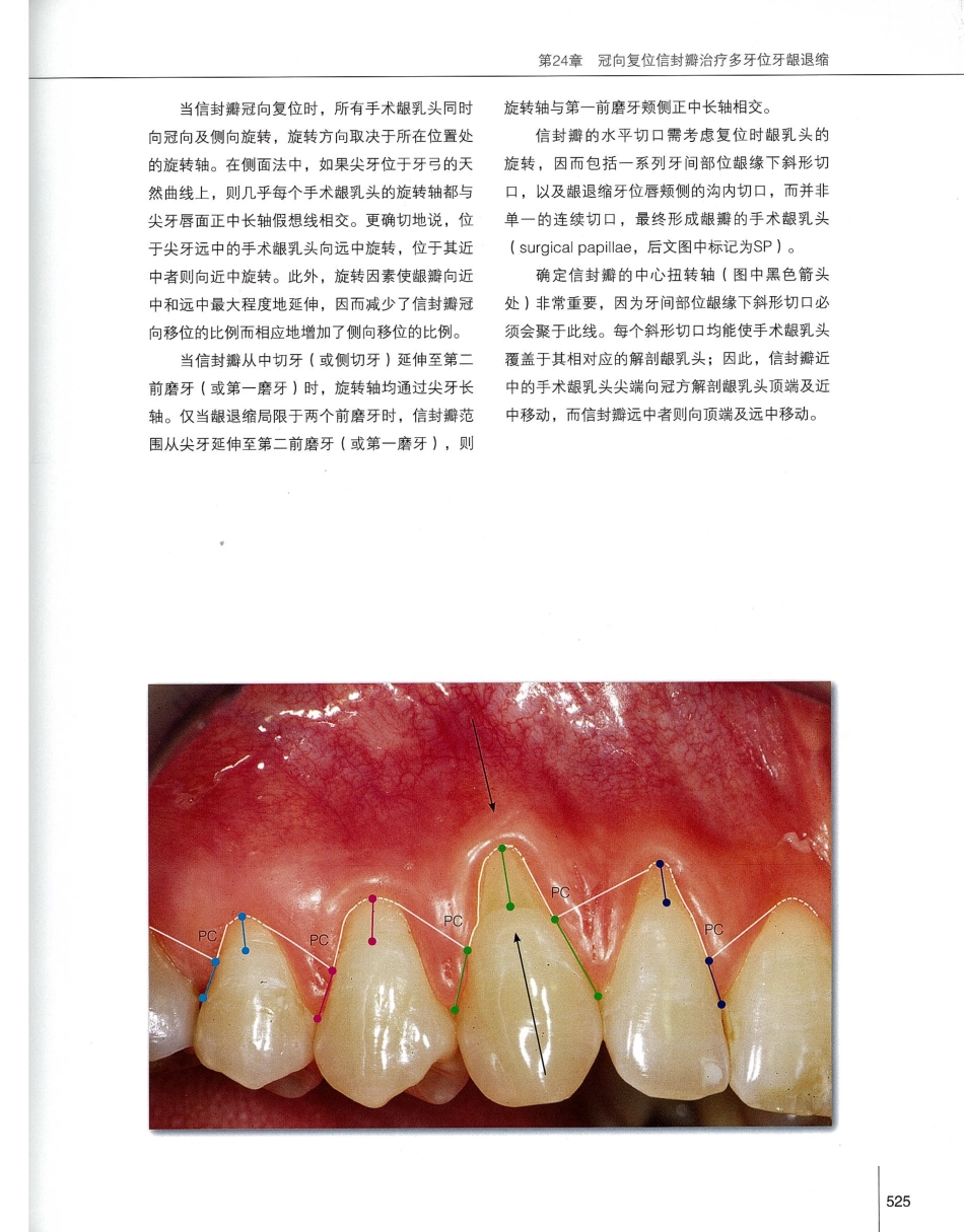 184膜龈美学手术精要_541-560.pdf_第2页