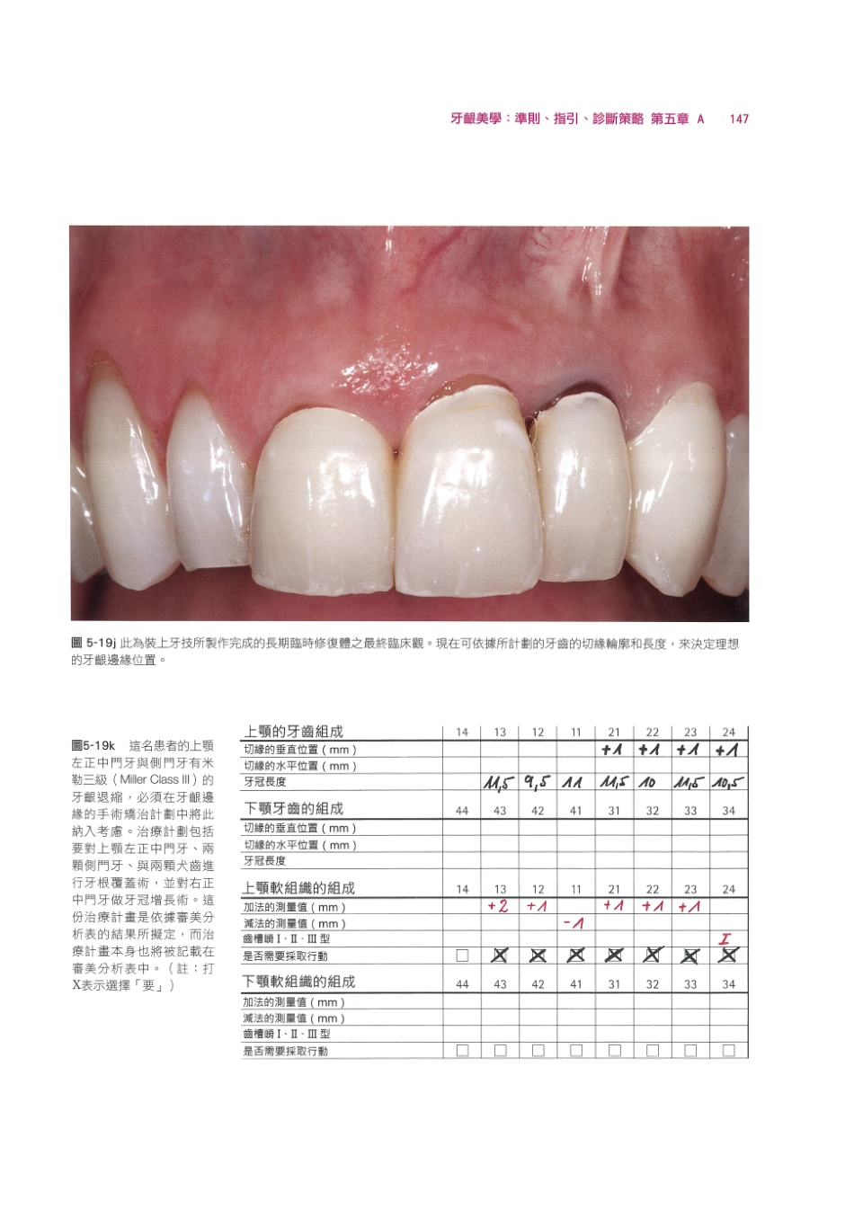 179.牙周整形美容与种植手术_161-168.pdf_第1页
