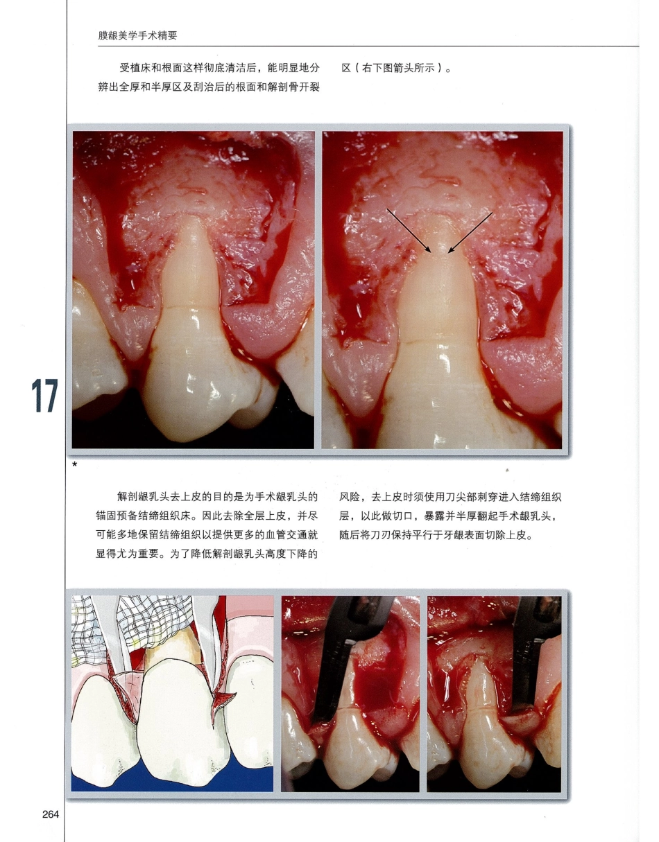 184膜龈美学手术精要_281-300.pdf_第1页