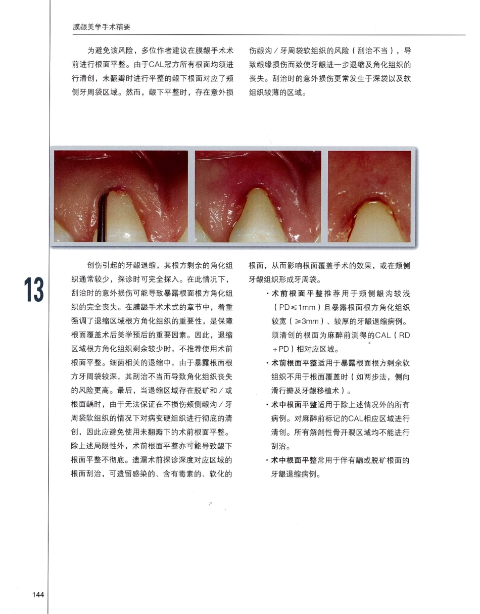 184膜龈美学手术精要_161-180.pdf_第1页