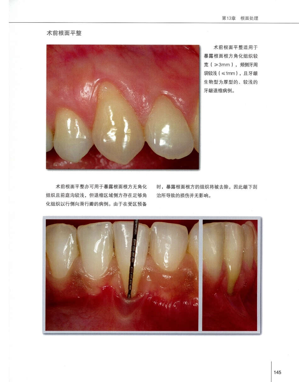 184膜龈美学手术精要_161-180.pdf_第2页