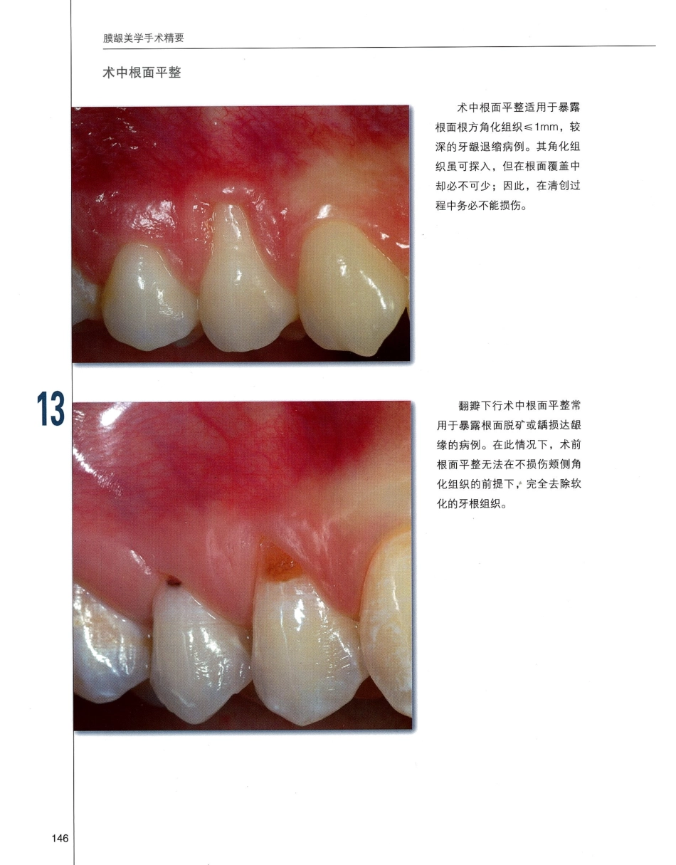 184膜龈美学手术精要_161-180.pdf_第3页