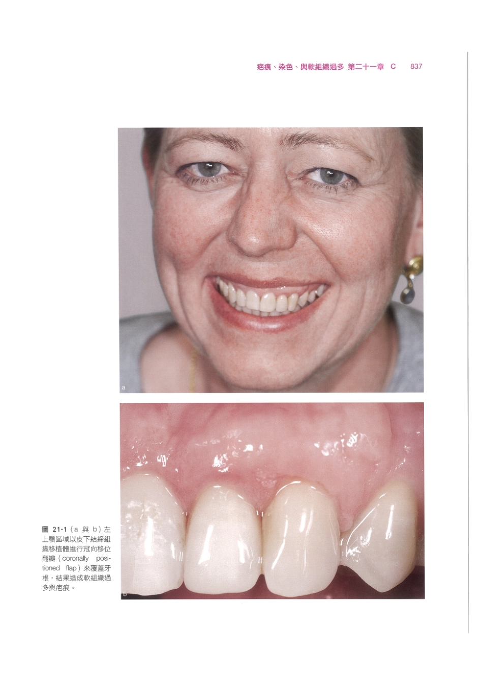 179.牙周整形美容与种植手术_849-856.pdf_第3页