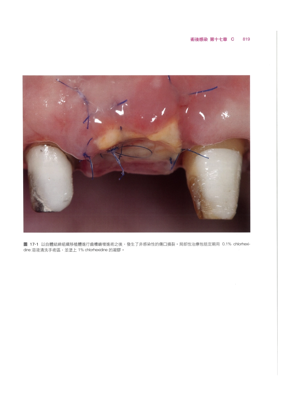 179.牙周整形美容与种植手术_833-840.pdf_第1页