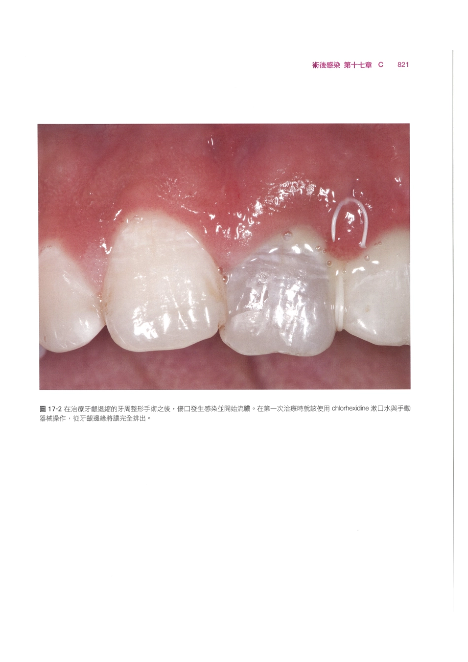 179.牙周整形美容与种植手术_833-840.pdf_第3页