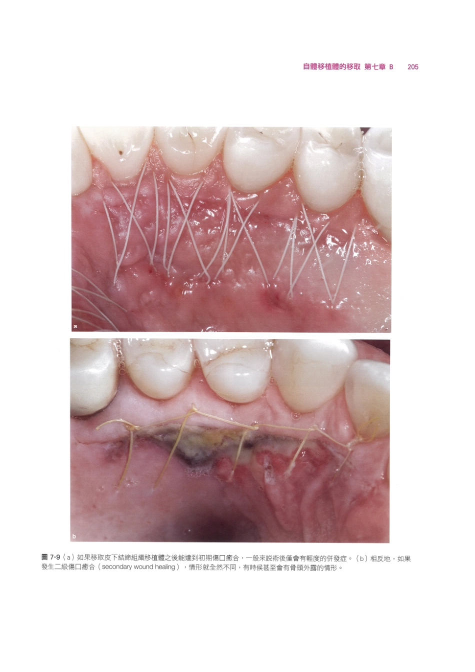 179.牙周整形美容与种植手术_217-224.pdf_第3页