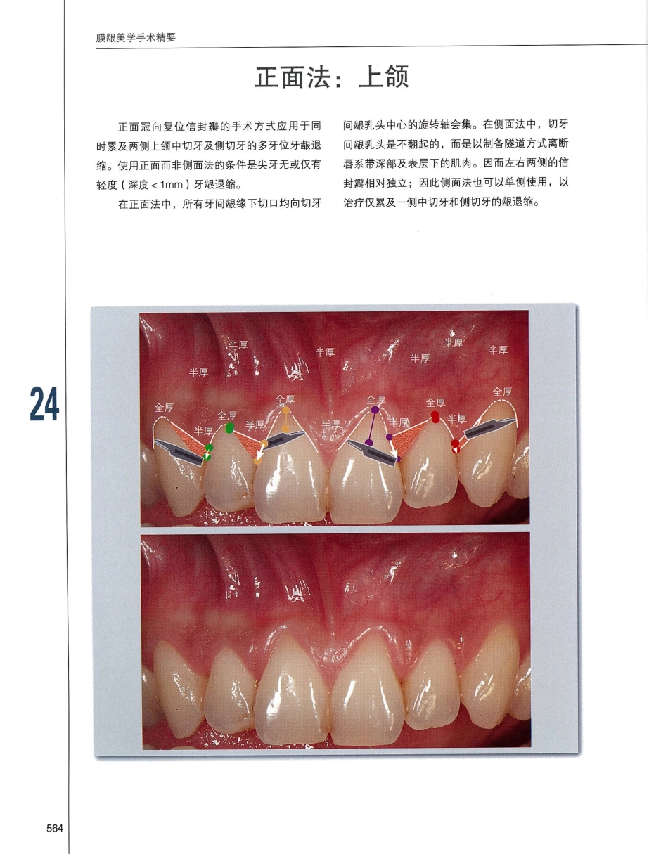 184膜龈美学手术精要_581-600.pdf_第1页