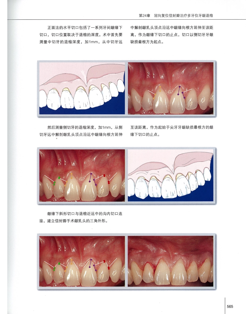 184膜龈美学手术精要_581-600.pdf_第2页