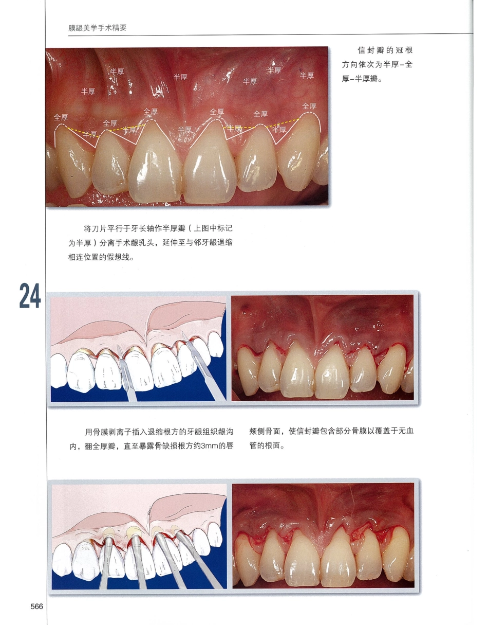 184膜龈美学手术精要_581-600.pdf_第3页