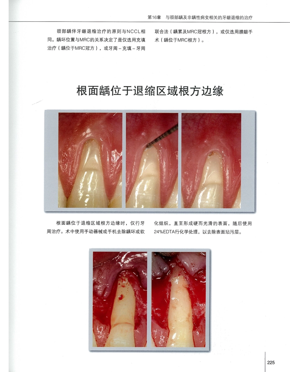 184膜龈美学手术精要_241-260.pdf_第2页