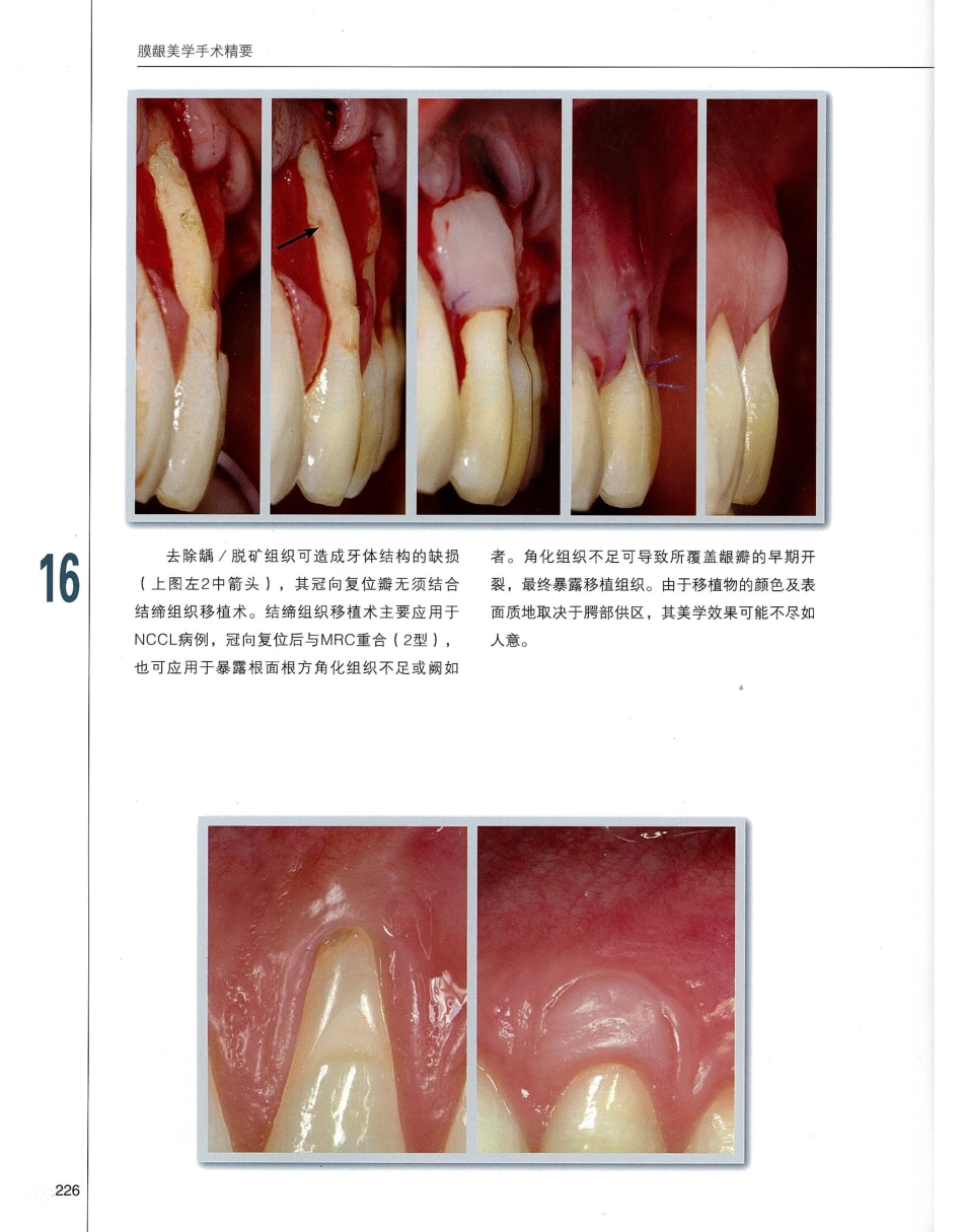 184膜龈美学手术精要_241-260.pdf_第3页