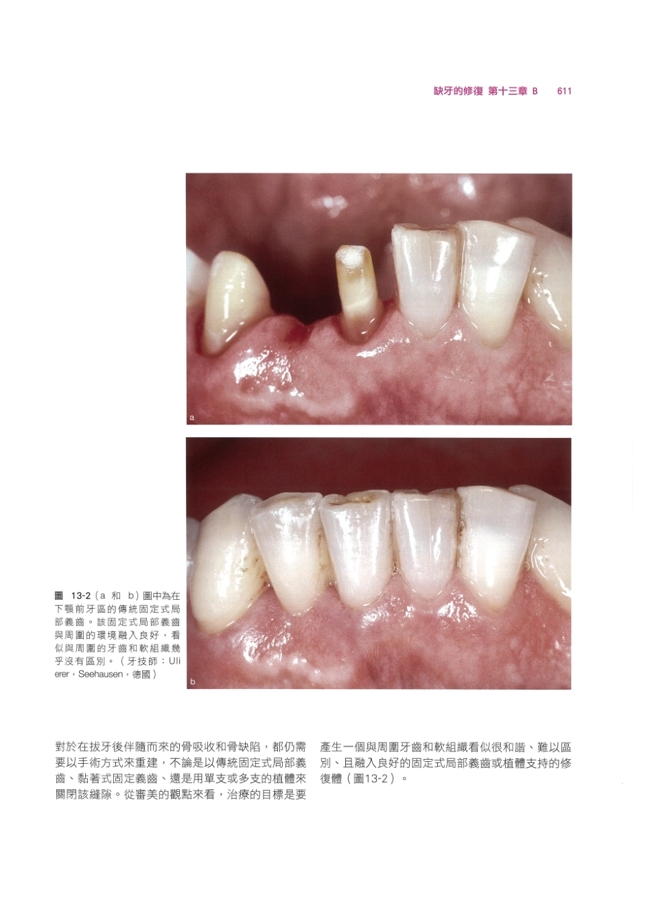 179.牙周整形美容与种植手术_625-632.pdf_第1页