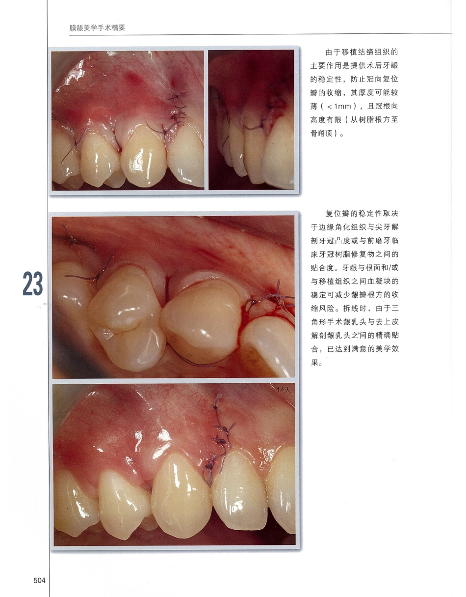 184膜龈美学手术精要_521-540.pdf_第1页