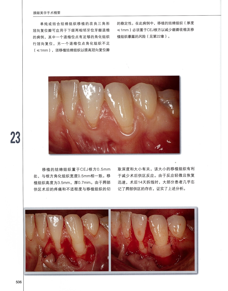 184膜龈美学手术精要_521-540.pdf_第3页