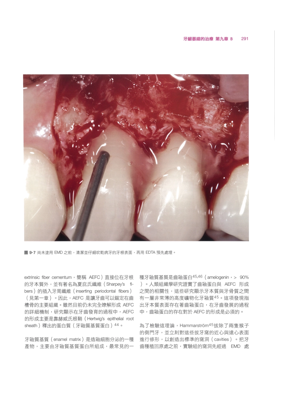 179.牙周整形美容与种植手术_305-312.pdf_第1页