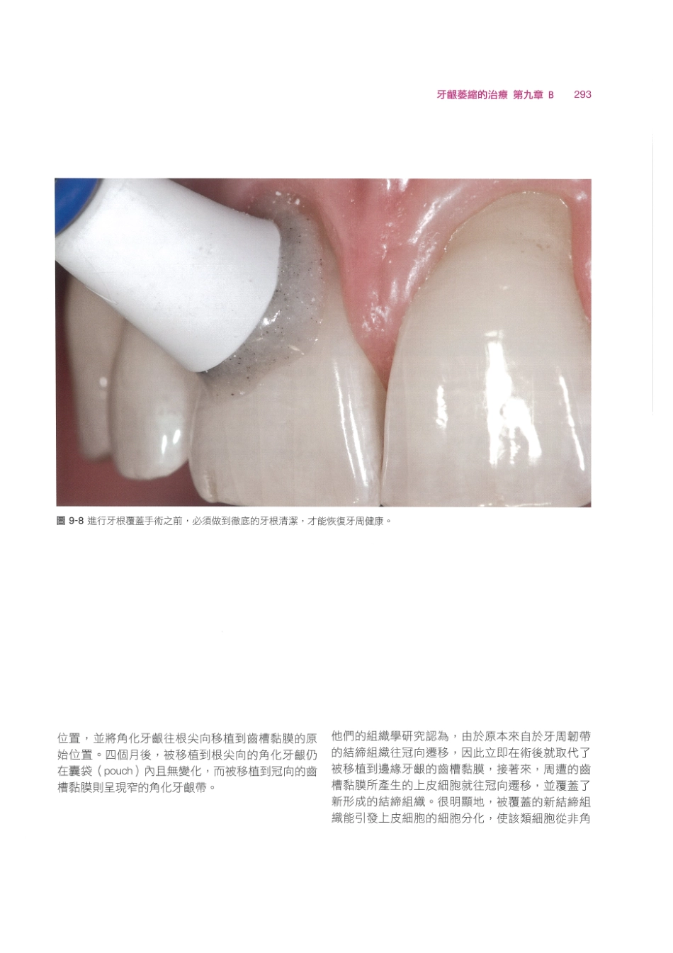 179.牙周整形美容与种植手术_305-312.pdf_第3页