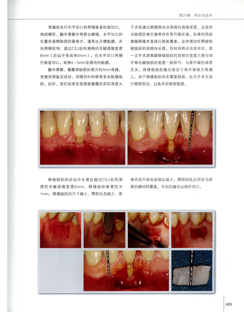 184膜龈美学手术精要_421-440.pdf_第2页