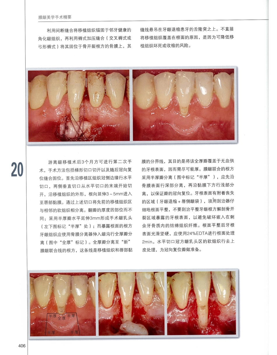 184膜龈美学手术精要_421-440.pdf_第3页