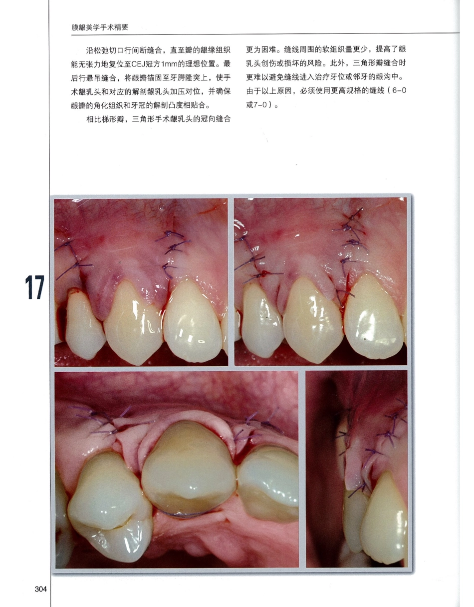 184膜龈美学手术精要_321-340.pdf_第1页