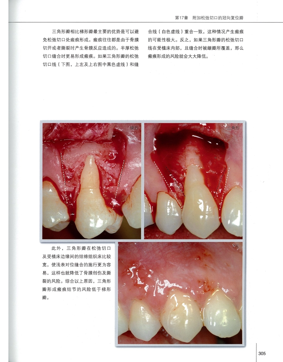 184膜龈美学手术精要_321-340.pdf_第2页
