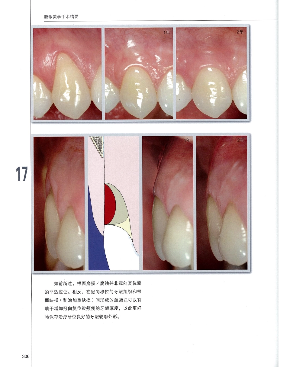 184膜龈美学手术精要_321-340.pdf_第3页