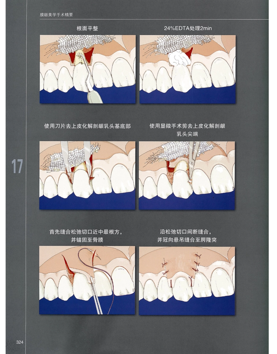 184膜龈美学手术精要_341-360.pdf_第1页