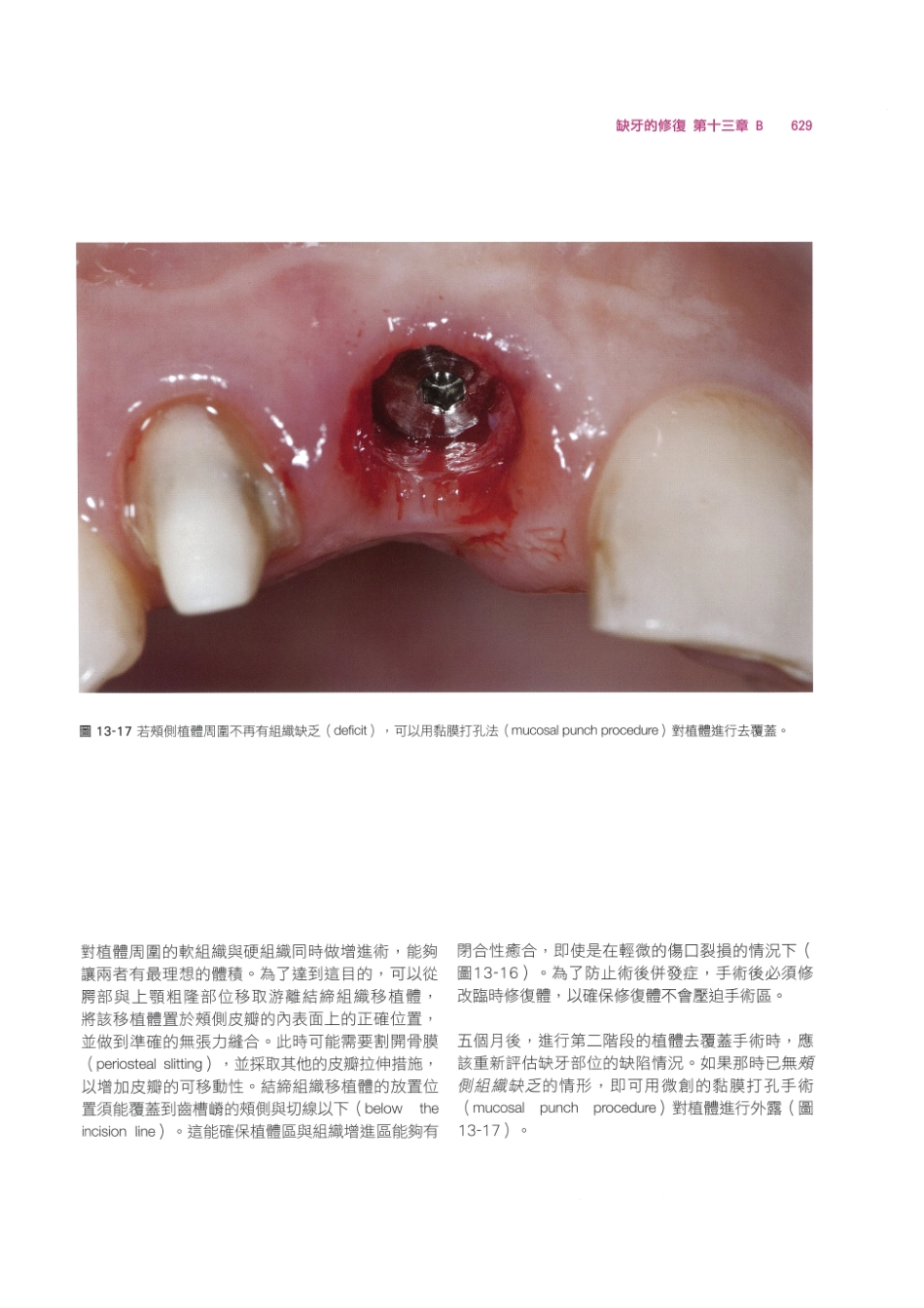179.牙周整形美容与种植手术_641-648.pdf_第3页