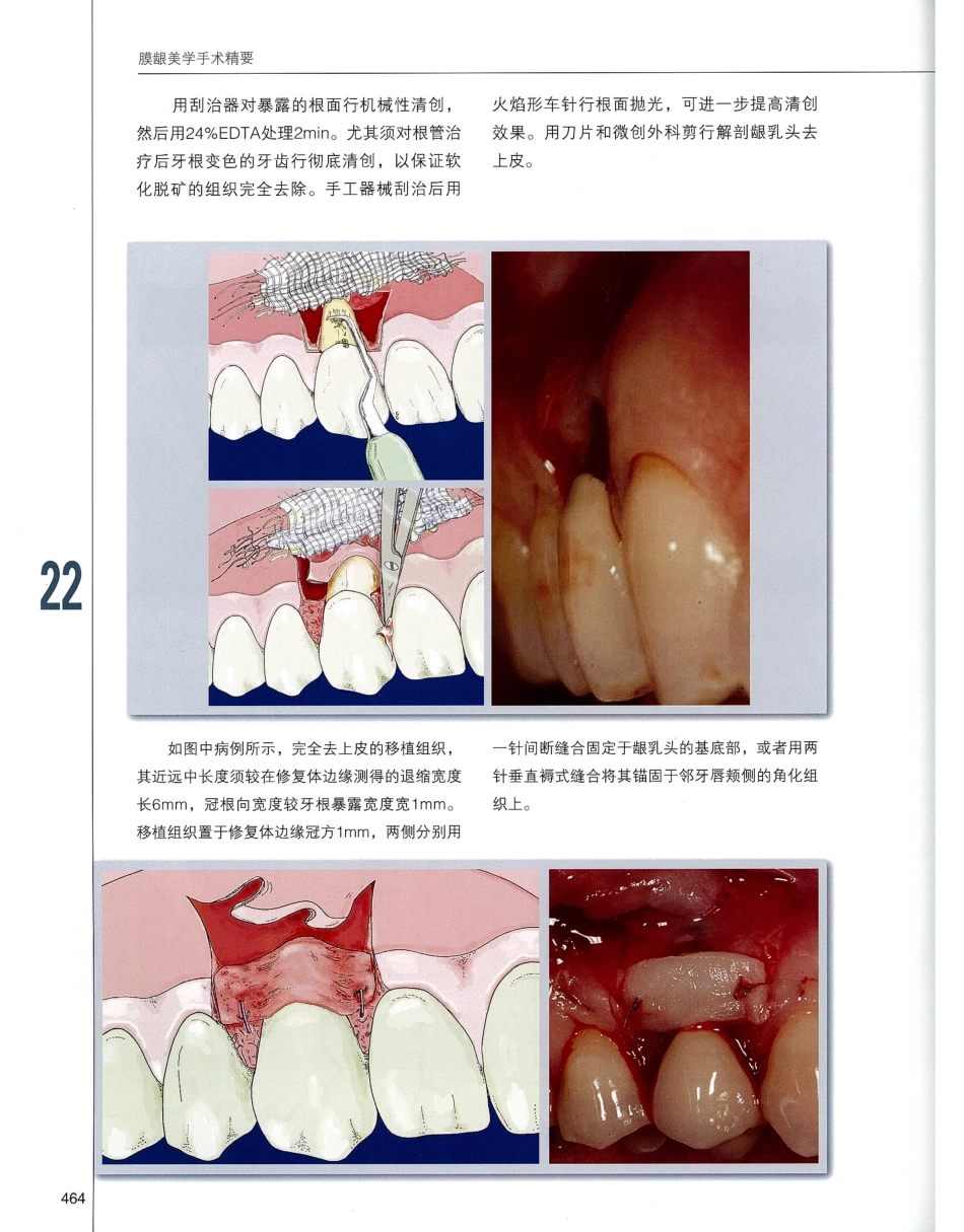 184膜龈美学手术精要_481-500.pdf_第1页