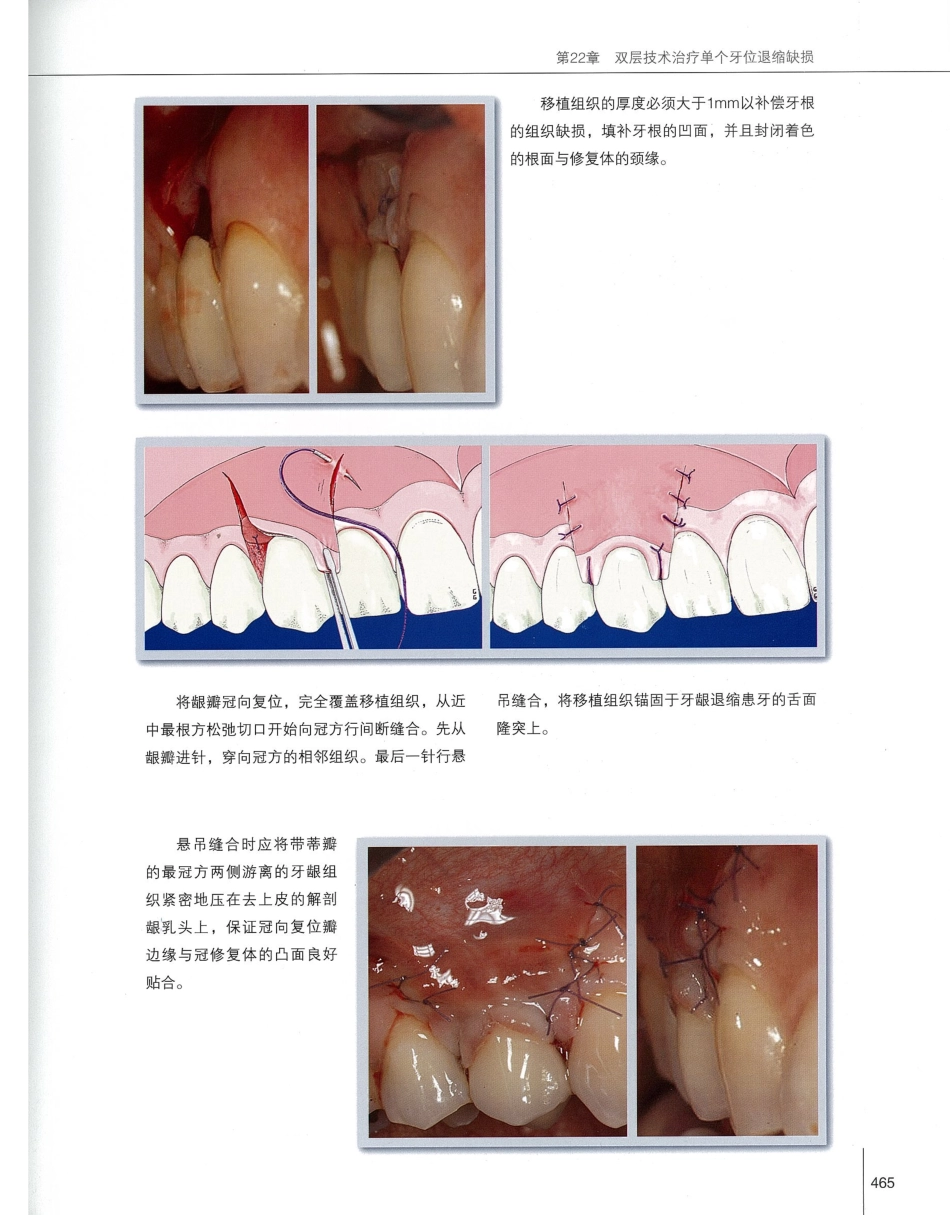 184膜龈美学手术精要_481-500.pdf_第2页